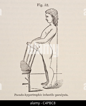 Illustrazione di pseudo-ipertrofico paralisi infantile circa 1881 Foto Stock