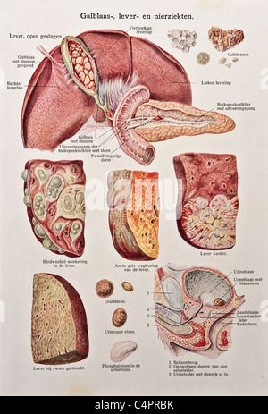 Malattie endocrine | cistifellea Foto Stock