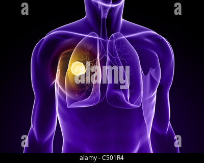 cancro del polmone Foto Stock