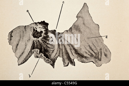 Anatomia di malattie intestinali tra cui il cancro Foto Stock