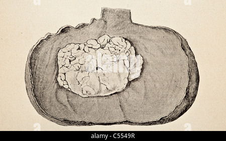 Anatomia di malattie intestinali tra cui il cancro Foto Stock