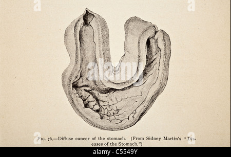 Anatomia di malattie intestinali tra cui il cancro Foto Stock