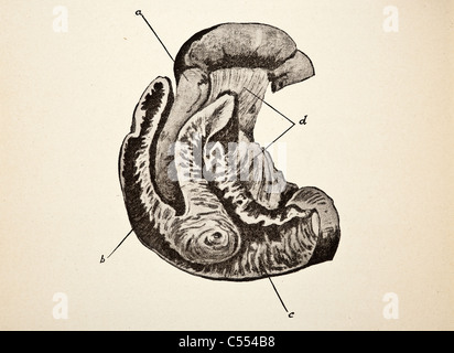 Anatomia di malattie intestinali tra cui il cancro Foto Stock