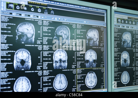 Scansioni cerebrali sulla scatola di luce Foto Stock