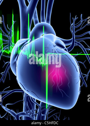 Un attacco di cuore e tracciato ECG Foto Stock