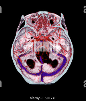Le arterie del cervello, 3D CT scan Foto Stock