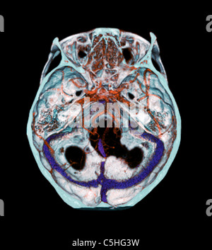 Le arterie del cervello, 3D CT scan Foto Stock