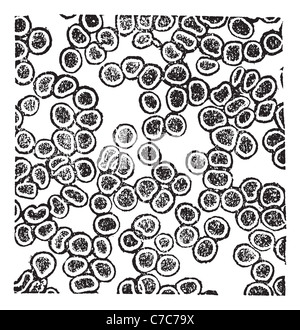 Globuli rossi o eritrociti, vintage incisione. Vecchie illustrazioni incise le cellule rosse del sangue. Foto Stock