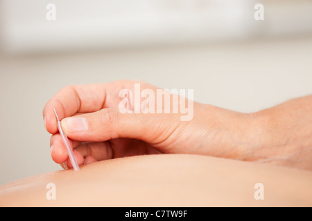 Macro dettaglio di una femmina di mano collocando un goshin aghi di agopuntura nella parte posteriore Foto Stock