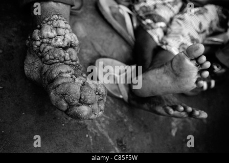 Un uomo con Podoconiosi infiammatorio cronico nei suoi piedi. Nord Kivu, Repubblica Democratica del Congo Africa Foto Stock