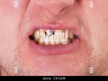 Giovane uomo faccia con perno del dente in bocca Foto Stock