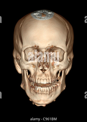 Cranio normale. Colorato 3D tomografia computerizzata (CT) Scansione del cranio sano di 36 anno vecchio paziente. Foto Stock