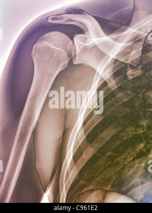 Spalla normale. Colorato X-ray dei sani spalla destra di 28 anno vecchio paziente. Foto Stock