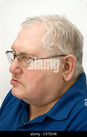 Uomo anziano soffre di Bell paralisi del Foto Stock