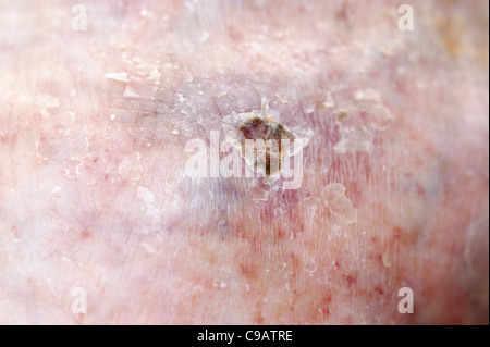 Una ulcera varicosa situato su una vena varicosa Foto Stock