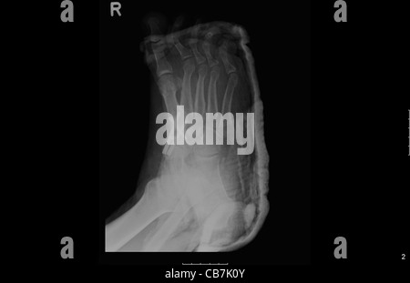 Piede e caviglia X-ray di 47 anno vecchio paziente di sesso maschile affetti da osteoartrosi Foto Stock