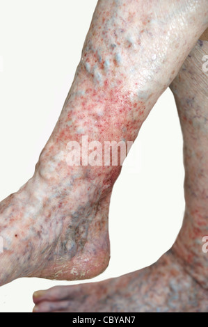 Donna anziana per le gambe che soffrono di eczema & vene varicose su sfondo bianco Foto Stock