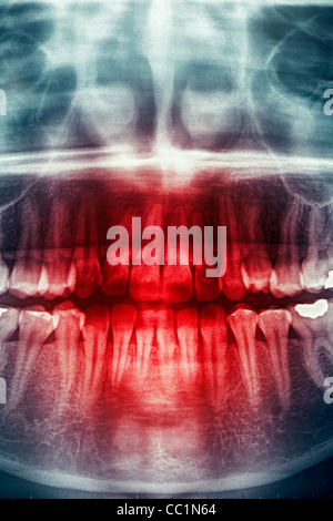 Dntal xray, orrore cranio Foto Stock