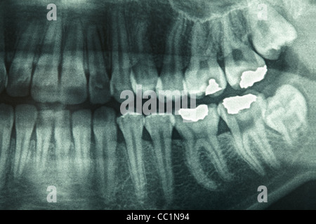 Raggi x dentali Foto Stock