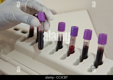 Un lavoratore di laboratorio prove sanguigna dei pazienti per la conta dei CD4 in corrispondenza di una infezione da HIV / AIDS clinica a Ibenga, Copperbelt Provincia, Zambia. Foto Stock