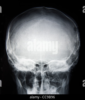 X-Ray immagine della base del cranio Foto Stock