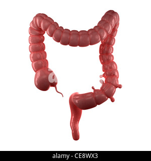 Diverticolosi. Illustrazione di computer di piccole sacche (diverticuli) nell'intestino crasso. Foto Stock