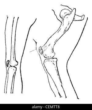 Rotula o patella o kneepan, vintage illustrazioni incise. Dizionario di parole e le cose - Larive e Fleury - 1895. Foto Stock