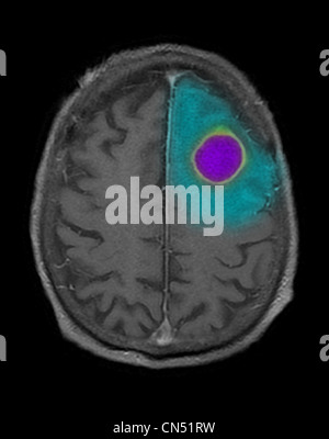 MRI scan slice attraverso il cervello di un 87 anno vecchio, mostrando un ascesso incapsulato nel lato sinistro del lobo frontale. Foto Stock
