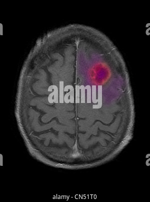 MRI scan slice attraverso il cervello di un 87 anno vecchio, mostrando un ascesso incapsulato nel lato sinistro del lobo frontale. Foto Stock