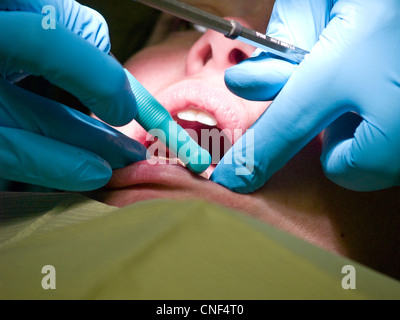 Una donna ha il suo denti puliti da un dentista prima di avere un canale radicolare fatto. Closeup shot della sua bocca e il medico le mani e th Foto Stock
