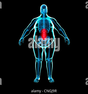 Dolore alla schiena in obesità illustrazione concettuale Foto Stock