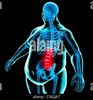 Dolore alla schiena in obesità illustrazione concettuale Foto Stock