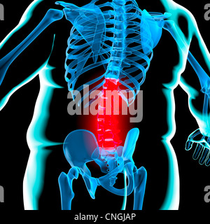 Dolore alla schiena in obesità illustrazione concettuale Foto Stock