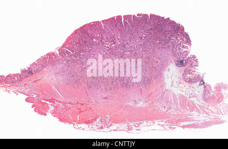 Close up invasivo delle cellule tumorali di colon Foto Stock