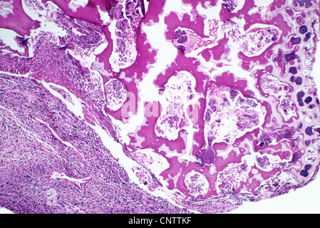 Le cellule infettate della piastra ossea Foto Stock