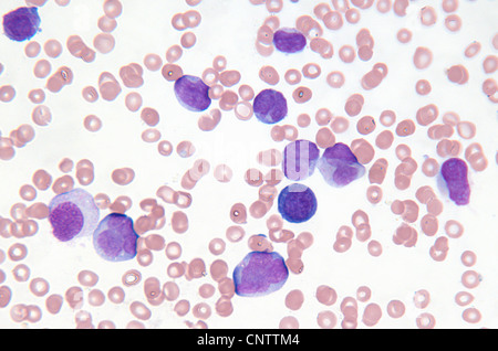 In prossimità di una leucemia mielogena cellule Foto Stock