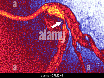 Infarto miocardico, ANGIOGRA. Foto Stock