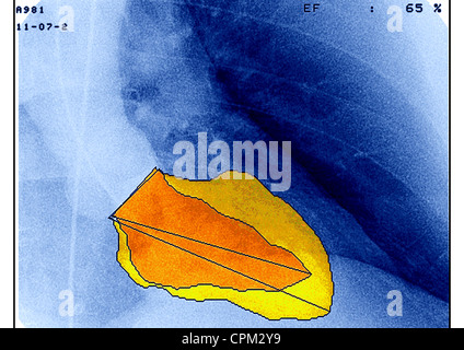 Attacco di cuore VENTRICULOGRAPHY Foto Stock