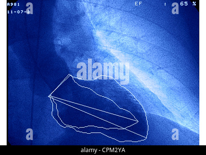 Attacco di cuore VENTRICULOGRAPHY Foto Stock