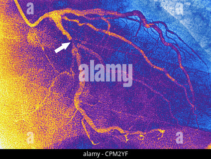 Infarto miocardico, ANGIOGRA. Foto Stock