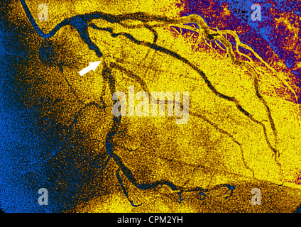 Infarto miocardico, ANGIOGRA. Foto Stock