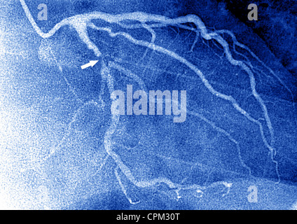 Infarto miocardico, ANGIOGRA. Foto Stock