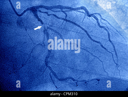 Infarto miocardico, ANGIOGRA. Foto Stock