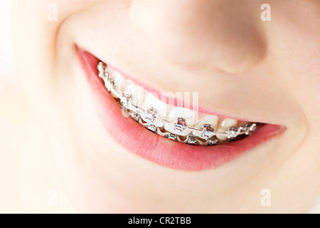 Primo piano sulle bretelle e denti bianchi della ragazza sorridente Foto Stock