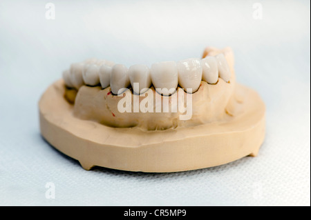 Ganascia superiore modello con corone in ceramica Foto Stock