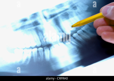 Persone, esseri umani, esseri umani (Homo sapiens sapiens), x-ray dei denti Foto Stock