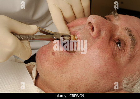 Un dentista del distacco di un uomo anziano il dente con una coppia di pinze chirurgiche. Foto Stock