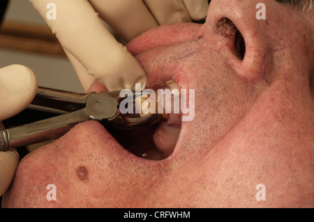 In prossimità di una estrazione del dente. Foto Stock