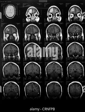 MRI scan delle persone cranio e cervello Foto Stock