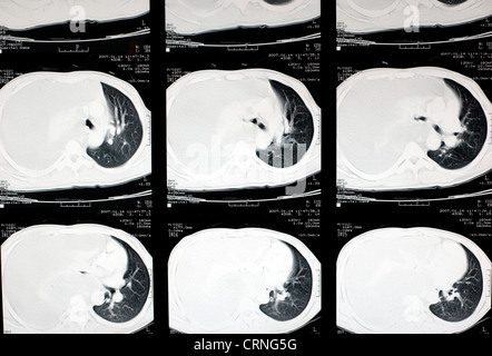 Una scansione CT che mostra un grave haemothroax sul lato destro del torace del paziente. Foto Stock